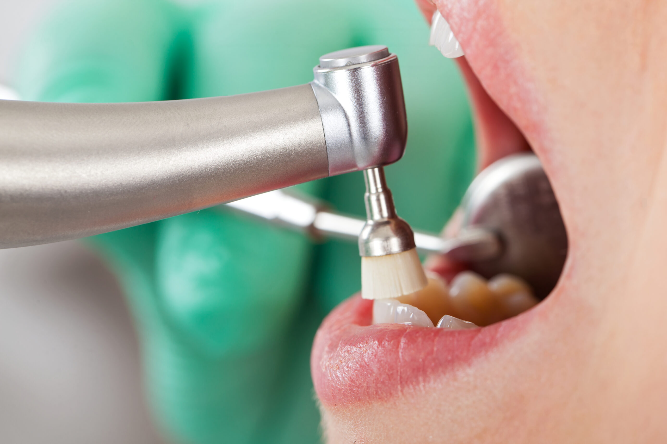 Professional,Dental,Cleaning,,Female,Patient's,Beautiful,Denture