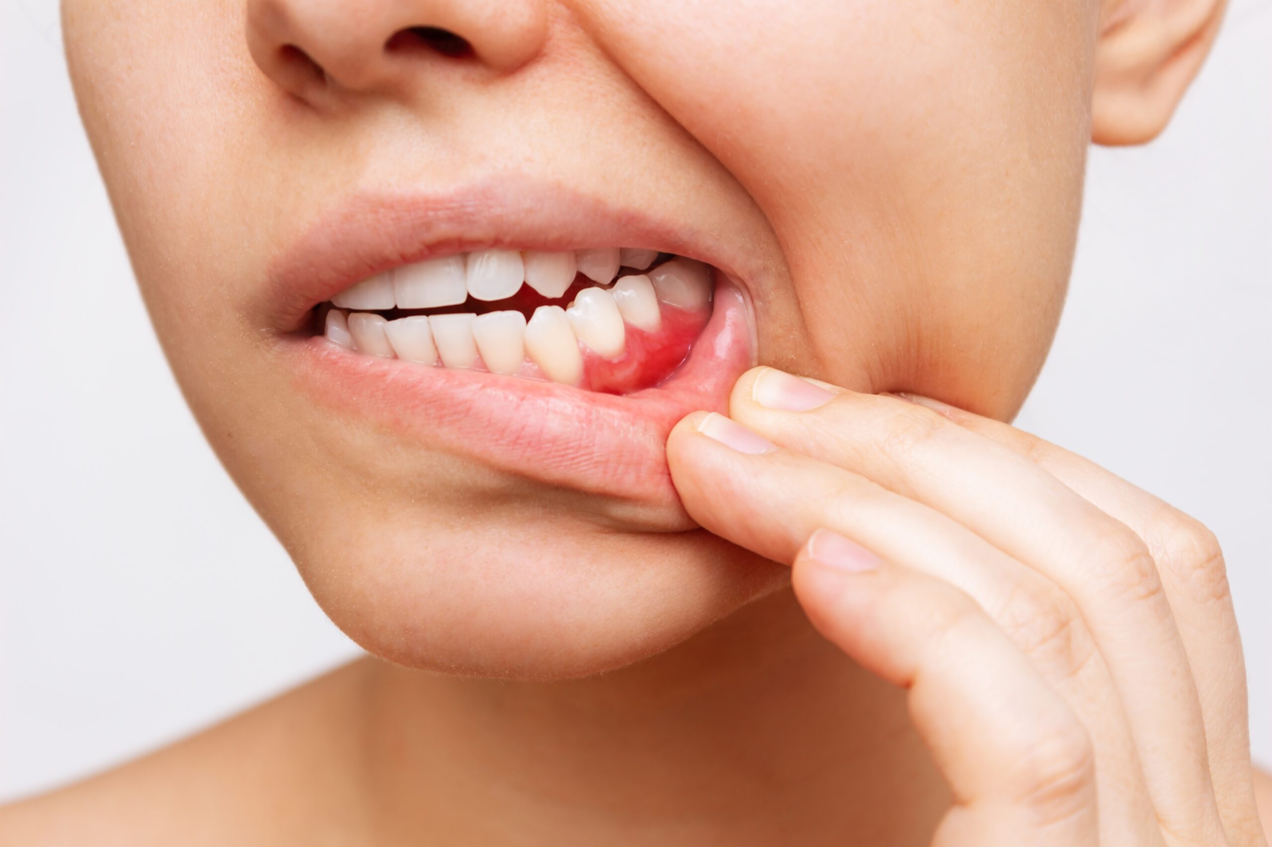 Gum,Inflammation.,Cropped,Shot,Of,A,Young,Woman,Showing,Red