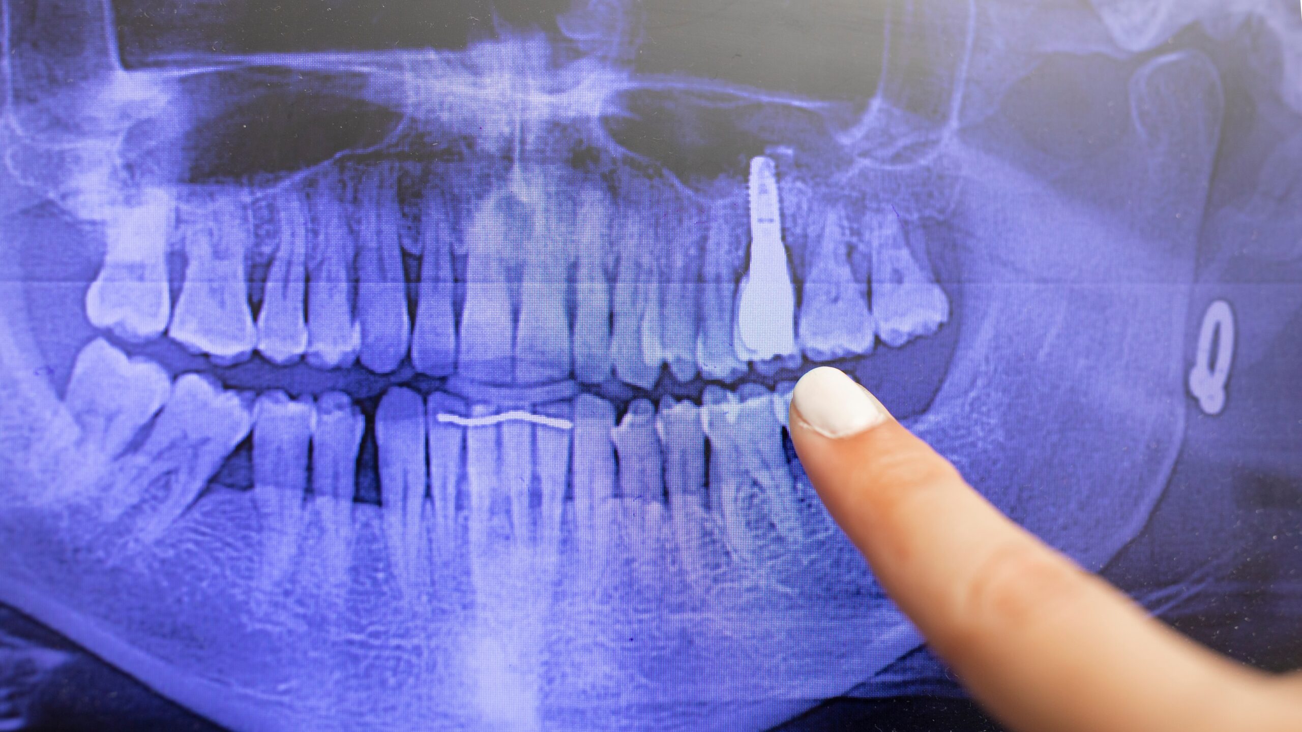 Detail,Of,A,Digital,Dental,Panoramic,Radiograph,,Taken,With,X-ray,