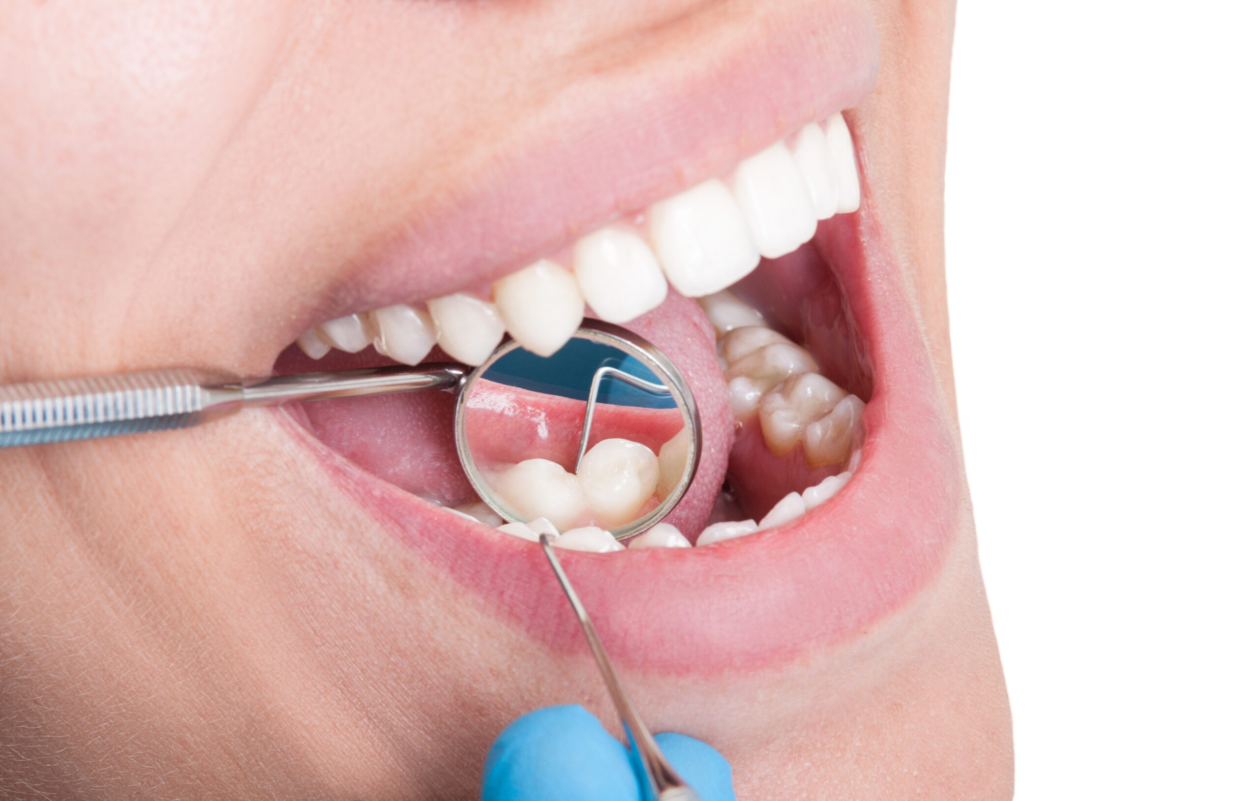 Closeup,Of,Dentist,Mirror,Reflecting,Lower,Teeth