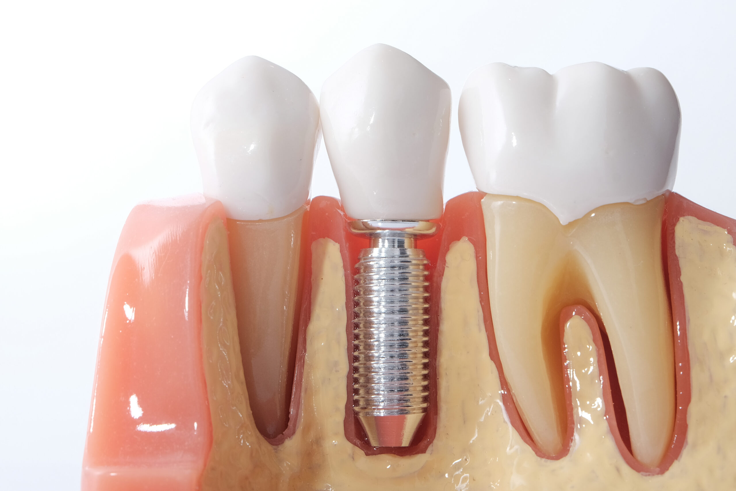 Generic,Dental,Implant,Study,Analysis,Crown,Bridge,Demonstration,Teeth,Model