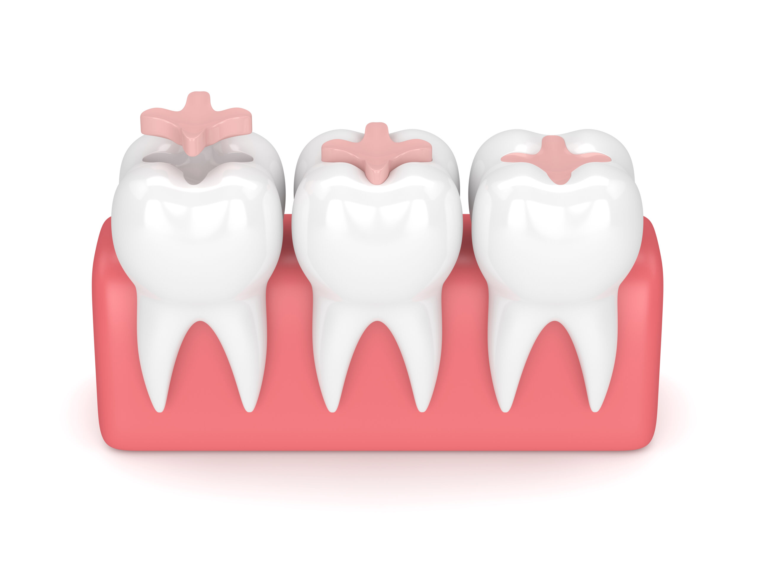 3d,Render,Of,Teeth,With,Dental,Inlay,Filling,In,Gums